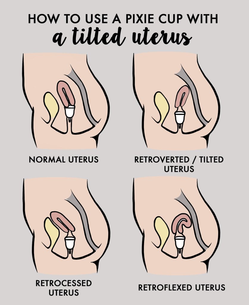https://www.pixiecup.com/wp-content/uploads/2020/04/menstrual-cup-with-tilted-uterus.jpg